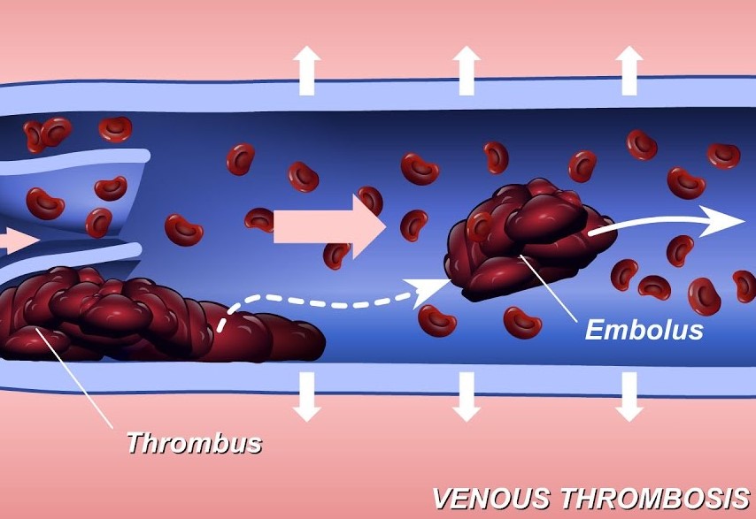 Venous Thrombosis