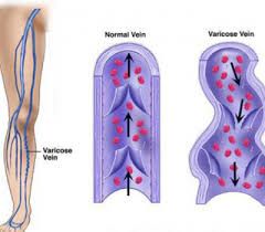 Venous hypertension