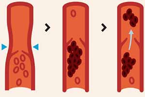 alleviate deep vein thrombosis