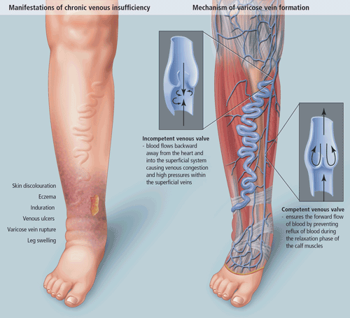 In case of venous insufficiency, doctor should be contacted as soon as possible.