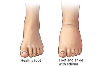 picture comparing healthy foot and foot with edema