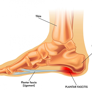 avoid plantar fasciitis