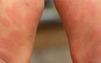 baby-legs-with-rash-angioedema