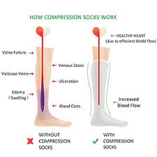 image showing benefits of anti-embolism stockings