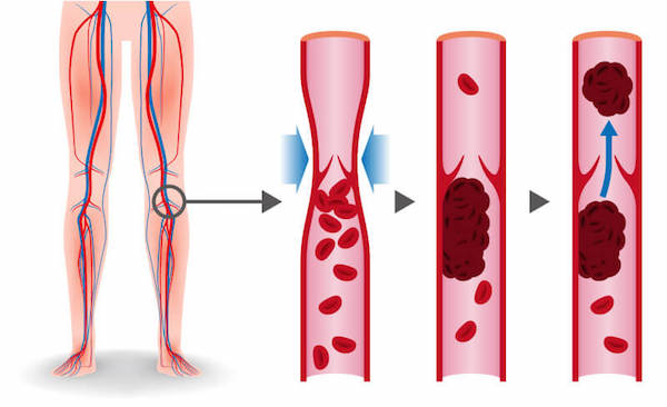 Forming of blood clots diagram