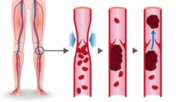 Wearing compression leg wear like compression socks or compression leg sleeves can help prevent blood clot and promote better blood flow