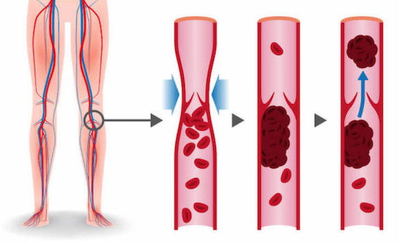Graphic of blood clots in the legs