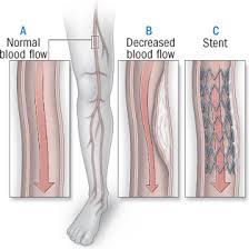 Normal blood flow vs unhealthy blood flow