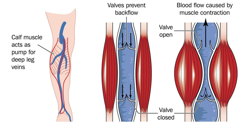 Graphic of the legs with healthy and damaged vein valves pumping blood