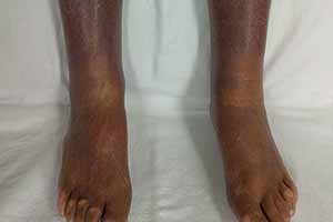 chronic venous insufficiency
