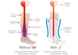 benefits of correctly using compression socks