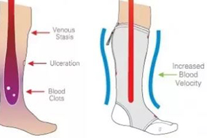 15 – 20 mmHg, 20 – 30 mmHg, or 30 – 40 mmHg knee high or thigh high compression socks can help prevent blood clots