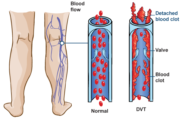 deep vein thrombosis