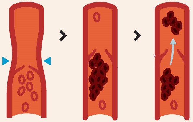 deep vein thrombosis