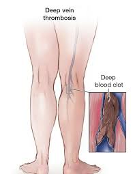 picture of human leg with deep vein thrombosis