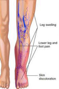 deep vein thrombosis