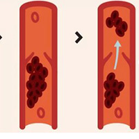 Image of deep vein thrombosis without proper compression socks protecting the leg veins from DVT