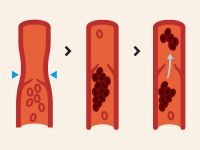 DVT symptoms