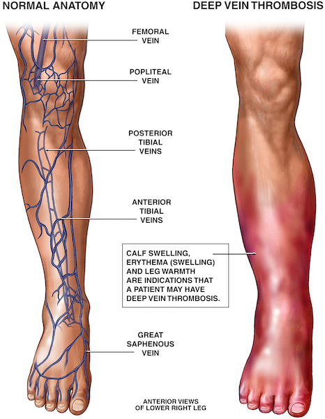 Graphic of Deep vein thrombosis