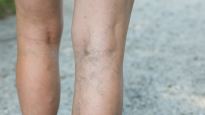 Image showing Deep vein thrombosis