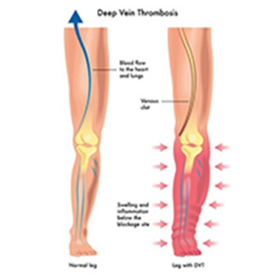 DVT chart