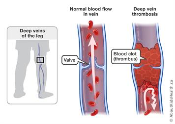 Wearing compression socks can prevent and treat deep vein thrombosis (DVT)
