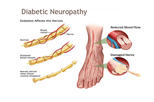 diabetic neuropathy