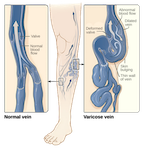 Varicose veins happen when the valves in the blood vessels no longer work, and blood cannot effectively pump back to the heart. Compression socks help support vein health and circulation.