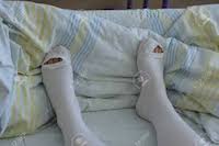 A patient wearing compression socks while in the hospital.