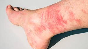 rashes after wearing socks 