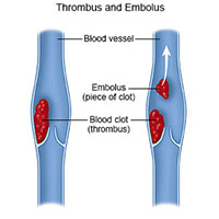 blood clots moving from one spot to another