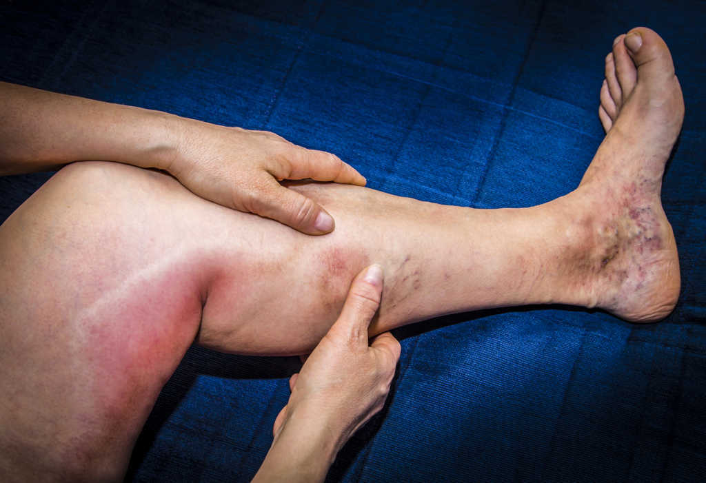 Image showing a leg with deep vein thrombosis