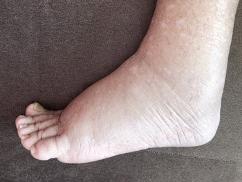 Edema, swollen, swelling