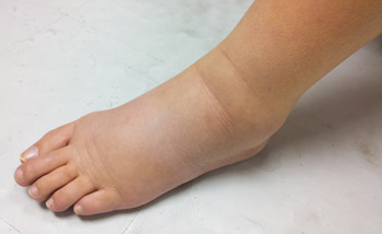 Symptoms of Edema, Swollen Foot