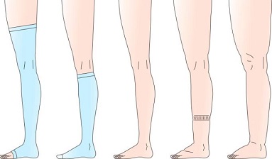 effect of compression socks on edema, knee high compression socks, thigh high compression socks