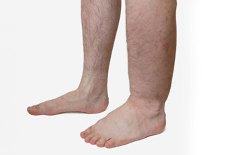 picture showing the difference between normal and swollen ankles and feet