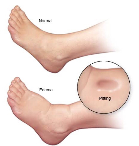 normal and foot with edema for compression socks