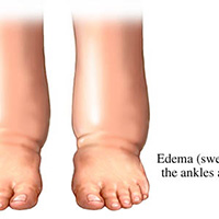 how edema looks like