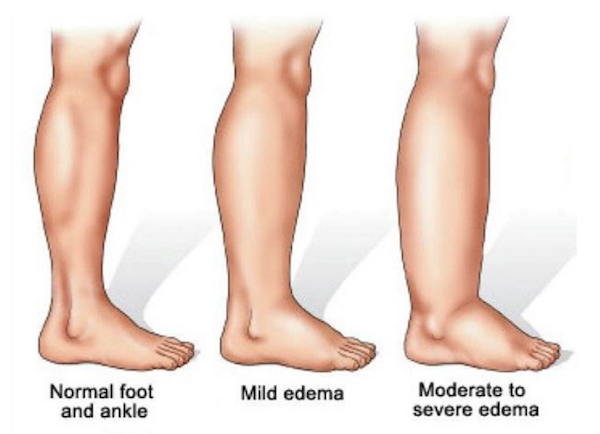 Wearing compression socks can prevent and treat edema