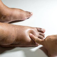 finger-testing-to-detect-swelling