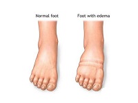 feet-needs-compression-stockings-for-edema