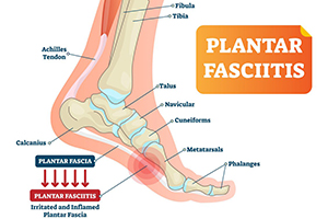 getting a detailed understanding of plantar-fasciitis