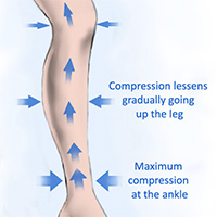 Gradient Compression Socks push blood up the leg to decrease foot, ankle, and calf swelling