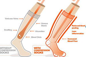 Compression Socks Running - Should You 