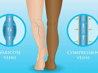 heal varicose veins with wide-calf-pressure-hoses