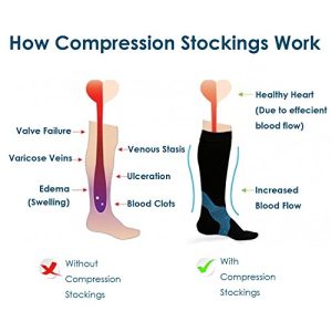 Compression Socks For Ankle Swelling - (With Pictures!)