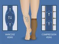 Compression socks help with blood flow by compressing the vein making blood flow more effective. This picture shows how compression socks can help with varicose veins more specifically.