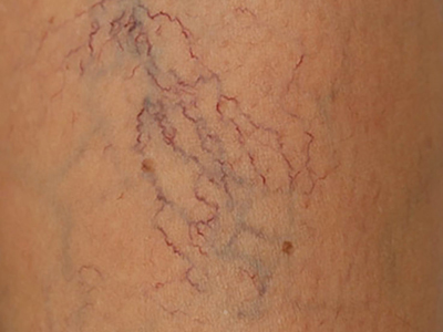 how spider veins look like