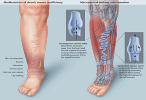 Compression Stocking Strength - Complete Guide (with Photos!)