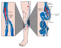 Compression Stocking Strength - Complete Guide (with Photos!)